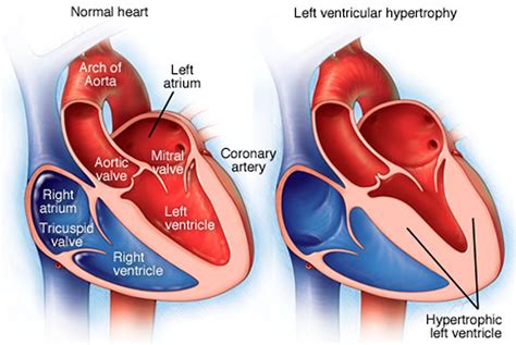 reasons for left ventricular hypertrophy